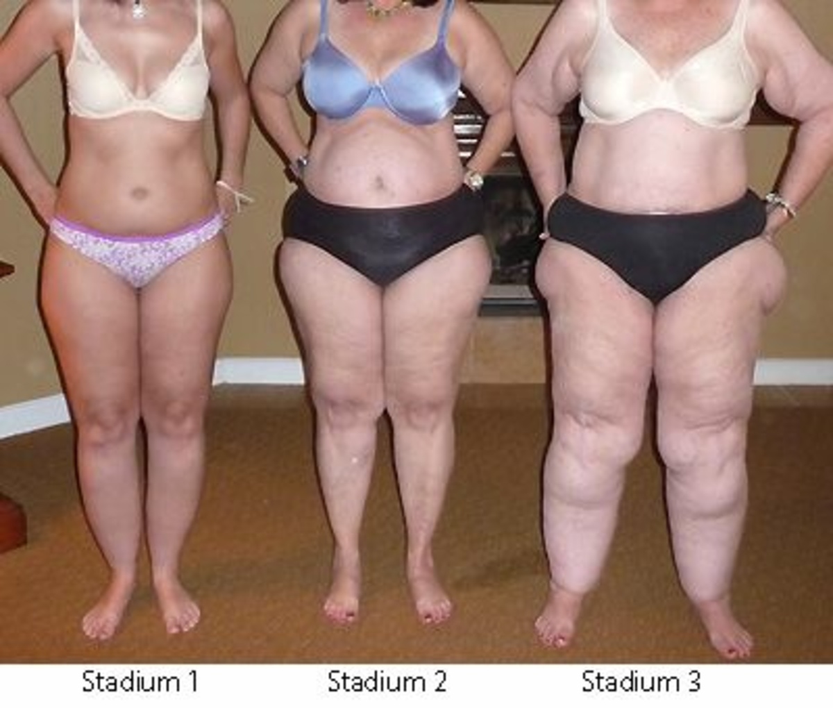 Lipedema (also known as Lipoedema or Lipodema) is a pernicious